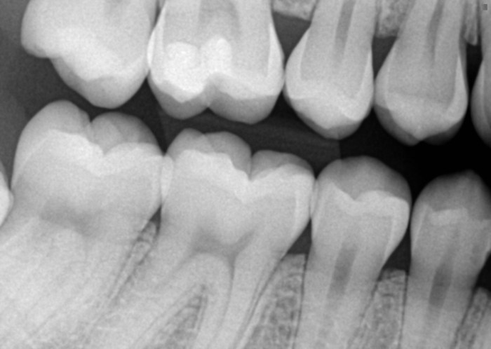 Type of image used for interproximal examination