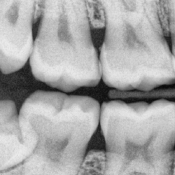 Bitewing rays xrays dental radiographs decay tooth proximal buyxraysonline dentagama disease periodontal initial roll zoom over gum