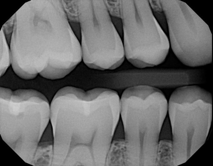 Type of image used for interproximal examination