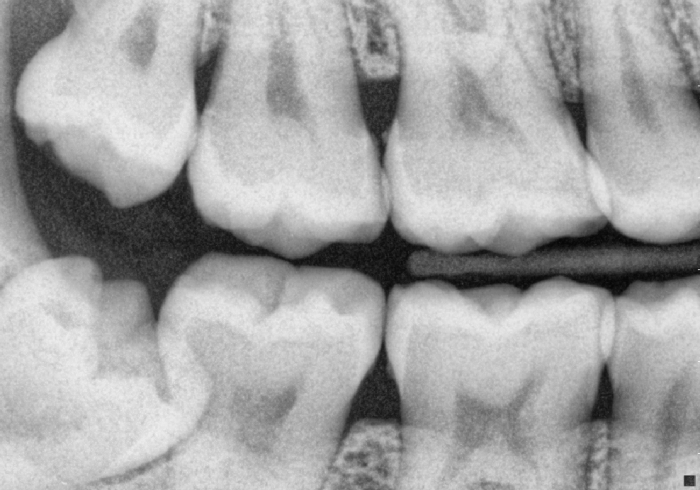 Bitewing rays xrays dental radiographs decay tooth proximal buyxraysonline dentagama disease periodontal initial roll zoom over gum